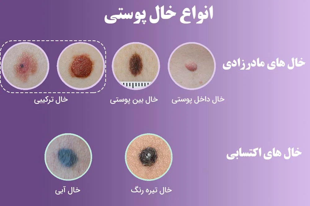 عکس خالهای گوشتی سرطانی