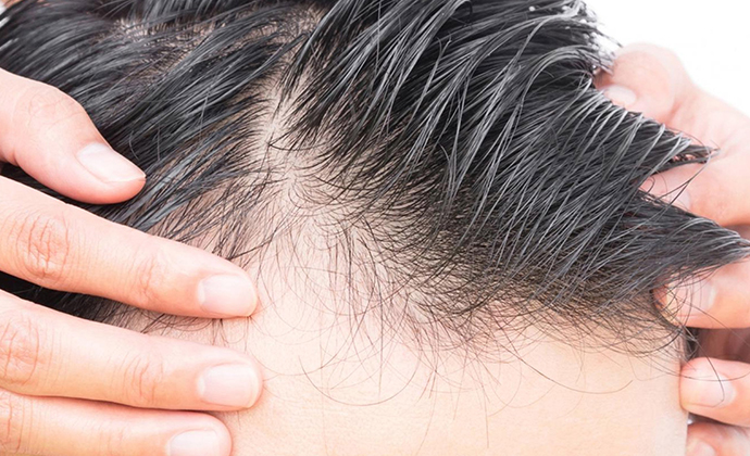 درمان طبیعی ریزش مو