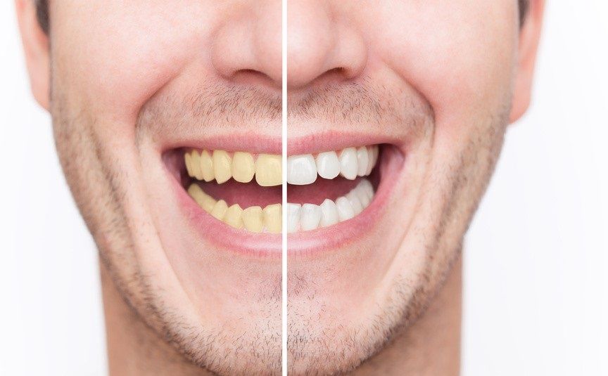 سفید کردن دندان ها 