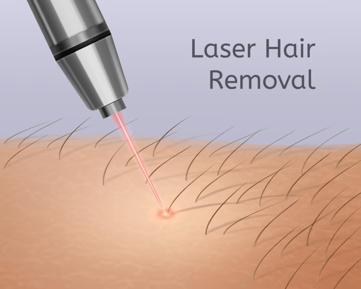 advantages-and-disadvantages-of-laser-hair-removal