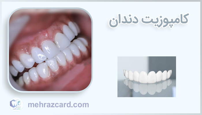 dental-composite