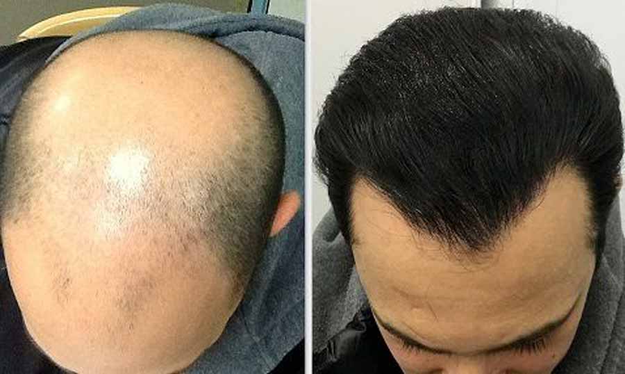بهترین کلینیک کاشت مو
