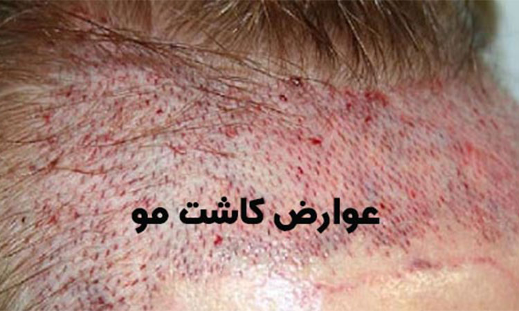 عوارض کاشت مو