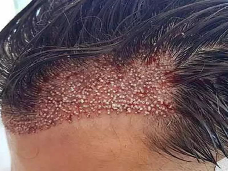 عوارض کاشت مو