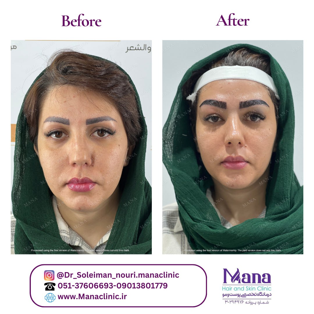 بهترین مرکز کاشت ابرو در مشهد