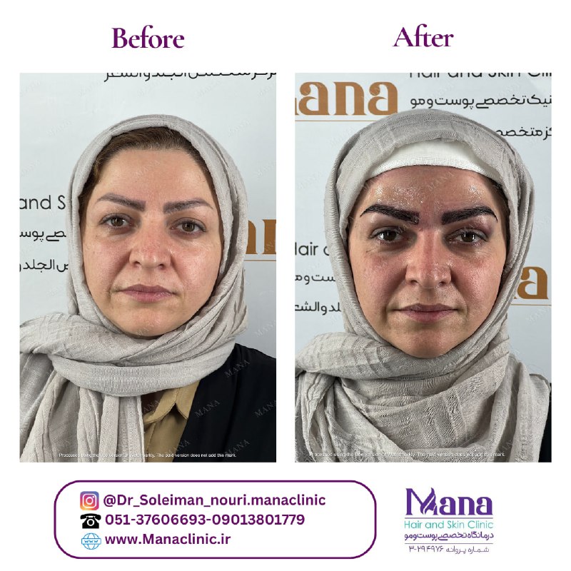 بهترین مرکز کاشت ابرو در مشهد