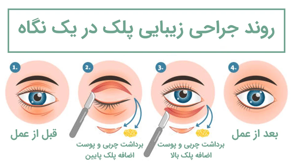 مراقبت های بعد از بلفاروپلاستی