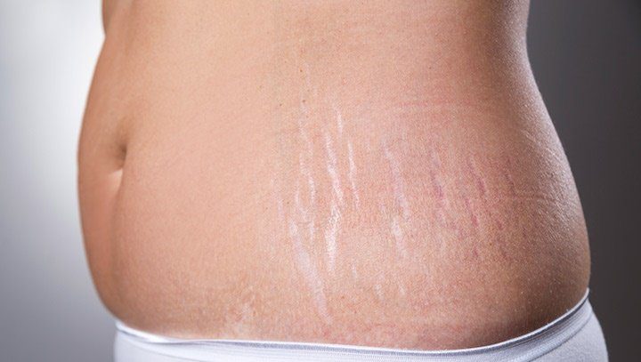 کاموفلاژ ترک پوستی چیست؟